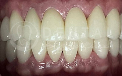 Dental Crowns, Bridge and Veneers