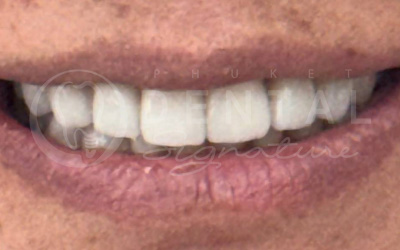 Dental Crowns, Bridge and Veneers