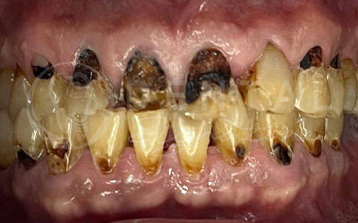 Dental Crowns, Bridge and Veneers