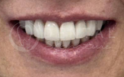 Dental Crowns and Veneers