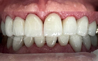 Dental Crowns and Veneers