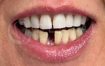 Dental Crowns and Veneers