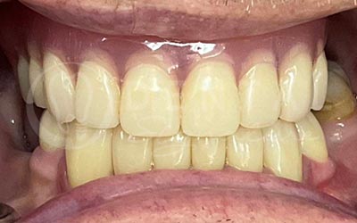 All-on-4 Upper jaw and 8 Crowns Lower jaw All-on-4 Upper jaw and 8 Crowns Lower jaw