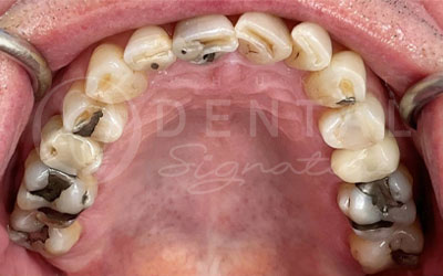 Dental Crowns, Bridge and Veneers