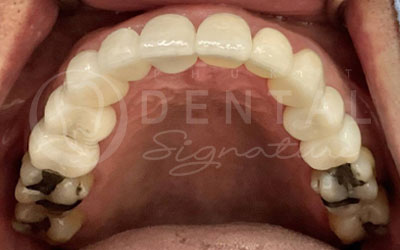 Dental Crowns, Bridge and Veneers
